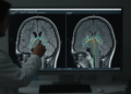 Parkinson’s MRI review finds lower locus coeruleus signal at group level