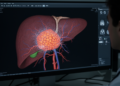 MRI radiomics predicts microvascular invasion in small hepatocellular carcinoma