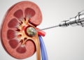 Needle-Sized Kidney Stone Surgery Shows Promise, But Superiority Not Proven