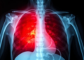As Immunity Falls, Tuberculosis in HIV Wears a Different Face on the Chest X-Ray