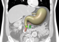 Gallbladder Fossa Depth on CT May Predict Catheter Path in Drainage Procedure