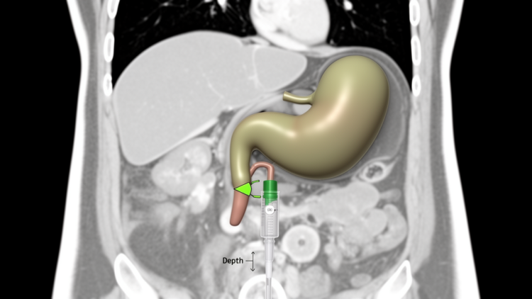 Gallbladder Fossa Depth on CT May Predict Catheter Path in Drainage Procedure