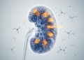 Counting Molecular Mismatches: HLA Eplet Analysis Moves Kidney Transplant Care Toward Precision Immune Risk Assessment