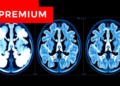 PET Scan Data Joins Clinical Factors to Predict Relapse in MALT Lymphoma