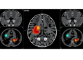 AI Reads MRI Scans to Predict Hidden Gastric Cancer Spread Before Surgery
