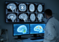 Super-resolution GAN and swarm-optimized transfer learning sharpen Alzheimer's MRI classification