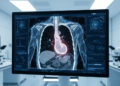 AI Model Reads CT Scans to Flag Hidden Esophageal Cancer Spread