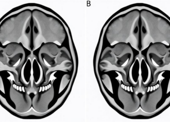 CT Mapping of Four Zygomatic Sutures Reveals Distinct Geometry and Uneven Left-Right Symmetry