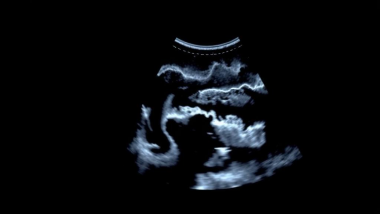 Ultrasound Offers an Objective Window Into Morphea Treatment Response
