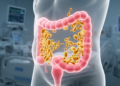 Anaemia and antifungal exposure flag Candida auris gut carriage in ICU