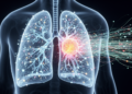 Neural network predicts three-year local recurrence after lung SBRT with higher accuracy than standard models
