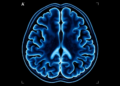 CT Scans Reveal First Brain Ventricular Norms for Healthy Bangladeshi Adults