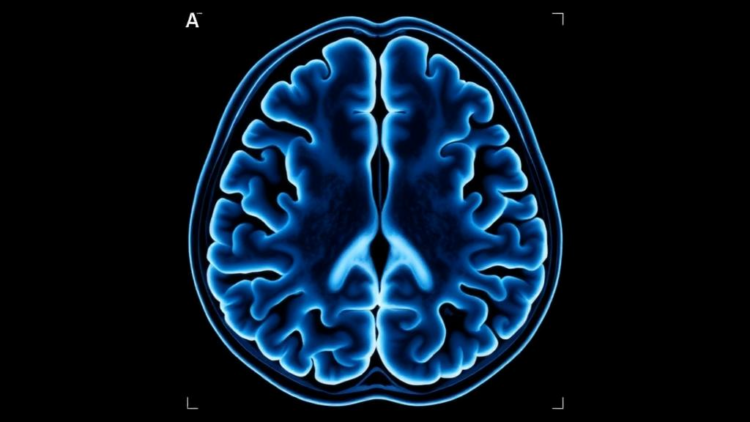 CT Scans Reveal First Brain Ventricular Norms for Healthy Bangladeshi Adults
