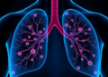 How Lung Cancer Rewires Fat Metabolism to Grow, Spread, and Evade Treatment