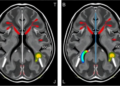 MRI-measured arterial enhancement volume flags early recurrence after liver cancer surgery