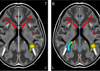 MRI-measured arterial enhancement volume flags early recurrence after liver cancer surgery
