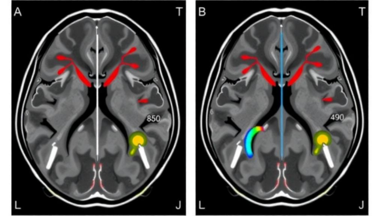 MRI-measured arterial enhancement volume flags early recurrence after liver cancer surgery
