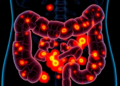 AI map of bowel tumours reveals drug vulnerabilities in hardest-to-treat colorectal cancer