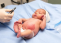 Emergency Embolization Rescues Newborn With Giant Forearm Hemangioma and Arteriovenous Fistula