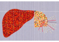 Spatial gene map reveals compartment-specific reprogramming in inflamed fatty livers