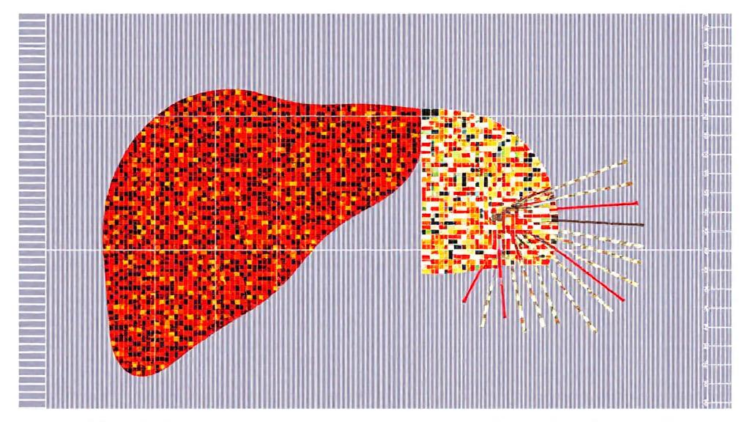 Spatial gene map reveals compartment-specific reprogramming in inflamed fatty livers