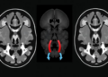 CTA Radiomics Model Distinguishes Symptomatic From Silent Vertebrobasilar Dissections