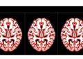 White Matter Tract Decline Tracks Cognitive Loss After Frontal Glioma Treatment