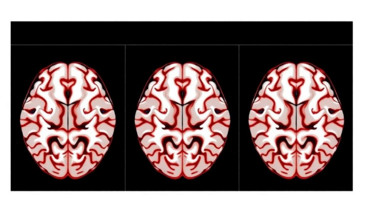 White Matter Tract Decline Tracks Cognitive Loss After Frontal Glioma Treatment