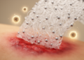 Flame-made nanosilver woven into chitosan fibers fights resistant wound bacteria