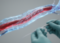 AI Moves Into Vascular Surgery, But Most Models Still Await Real-World Proof