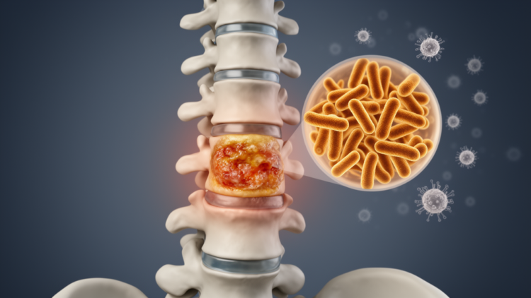 Rare Klebsiella Spinal Abscess Masqueraded as Tuberculosis in a Diabetic Patient