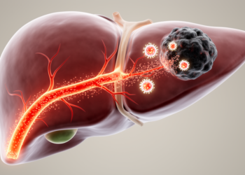 Combining Liver Artery Therapies With Immunotherapy Shows Survival Gains in Advanced Liver Cancer Review