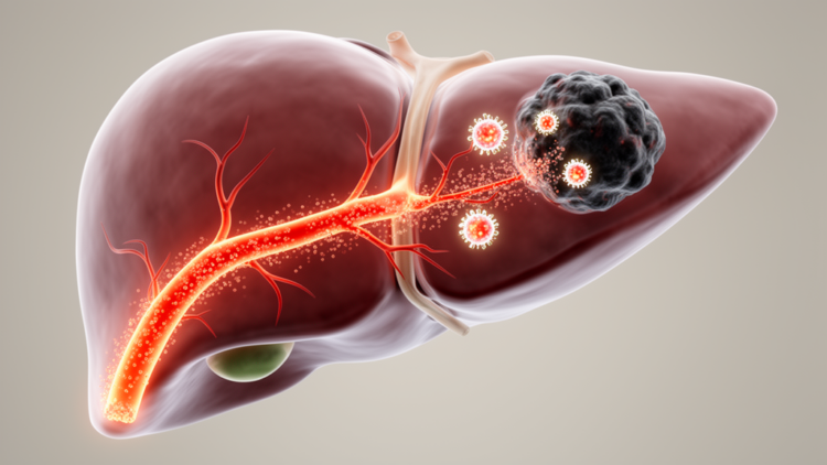 Combining Liver Artery Therapies With Immunotherapy Shows Survival Gains in Advanced Liver Cancer Review