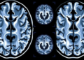 Brain Scans Reveal When Alzheimer's Damage First Appears in Younger Patients