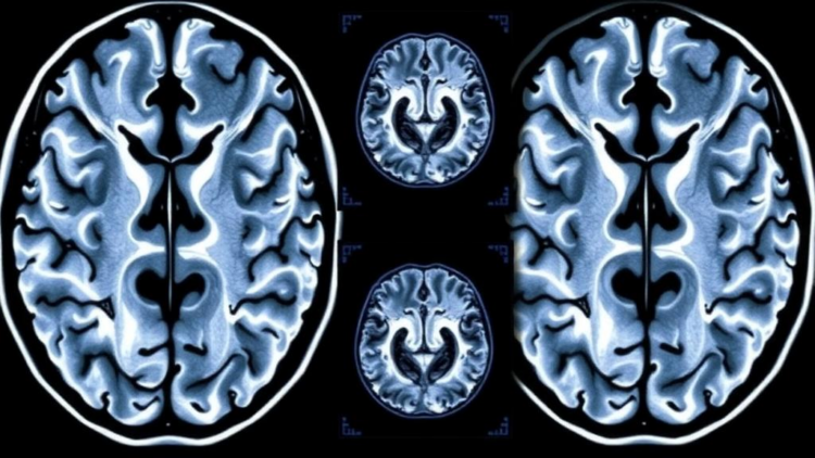 Brain Scans Reveal When Alzheimer's Damage First Appears in Younger Patients