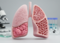 Research report: Clinicopathological and molecular correlates of micropapillary/solid and lepidic patterns in lung adenocarcinoma