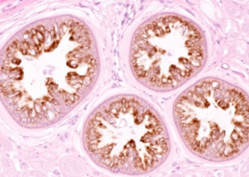 TRPC5 staining marks heterogeneous FSGS biopsy phenotype in clinical cohort