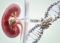 Case Report Identifies New TCEB1 Variant in Rare Kidney Cancer
