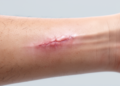 Meta-Analysis Links Keloid Combination Therapy to Better Outcomes