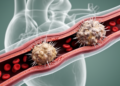 Two Eruptive Calcified Nodules Found in the Same Coronary Artery