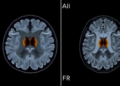 AI Reads Eye Scans: Machine Learning Spots Dangerous Orbital Tumors on MRI