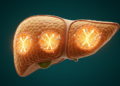 Androgen Receptor Signaling May Explain Why Liver Cancer Strikes Men Far More Often