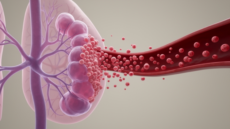 Lobular metastatic breast cancer sheds far more circulating tumor cells than ductal