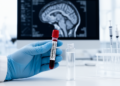Blood RNA patterns track essential tremor brain and cognitive differences