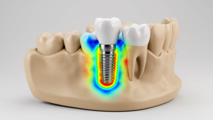 Finite-element study maps stresses around 4-mm ultra-short dental implants