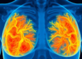 Scientists Map Hidden Lymphatic Damage in Breast Cancer Survivors Using AI