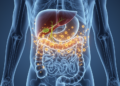 Hidden immune activity may explain colorectal cancer risk in PSC