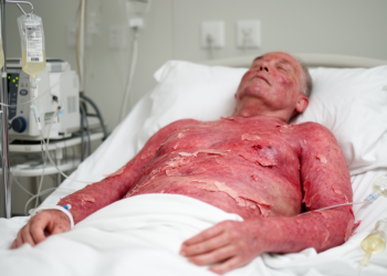 Single case links delayed fatal TEN to urothelial cancer combination therapy