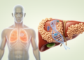Genetic and metabolic risks linked to early cirrhosis in adults with MASLD
