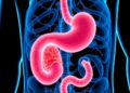 Pancreatic Cancer Is Being Caught Earlier Than Ever, Landmark 20-Year Analysis Finds